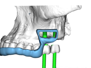 Surgical Guide LowWindow transparent