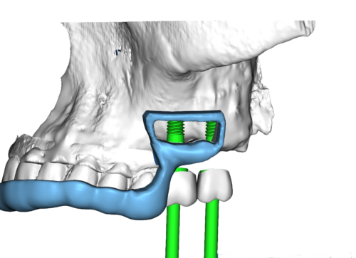 Surgical Guide LowWindow transparent