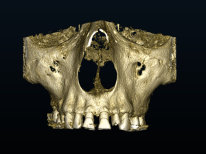 cbct